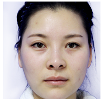 美萊案例袁婷對(duì)比圖后