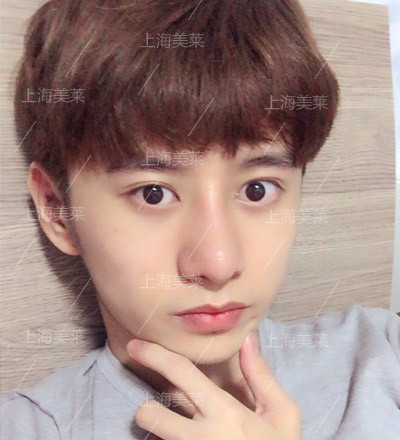 李?？?美萊自體軟骨隆鼻