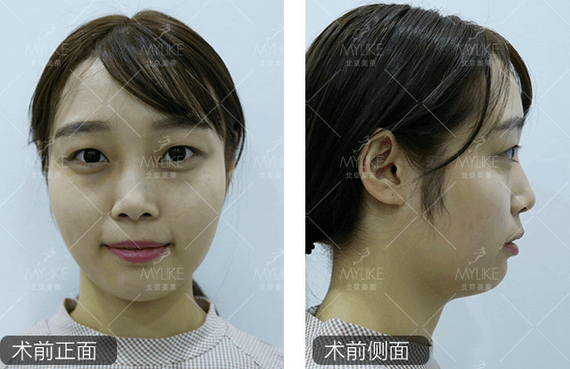 玻尿酸注射、+<a href='/bj/' target='_blank'><u>北京美萊</u></a>無創(chuàng)案例