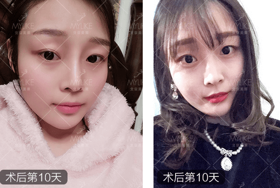 玻尿酸注射、+北京美萊無創(chuàng)案例