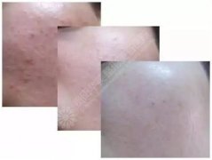 貴陽激光祛痘哪家醫(yī)院比較好？