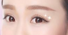埋線(xiàn)雙眼皮術(shù)后會(huì)掉線(xiàn)嗎