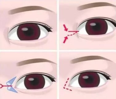 想要開(kāi)眼角先要了解這些問(wèn)題