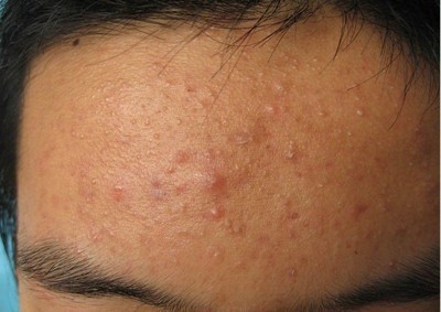 閉口和粉刺有什么區(qū)別，怎么祛除