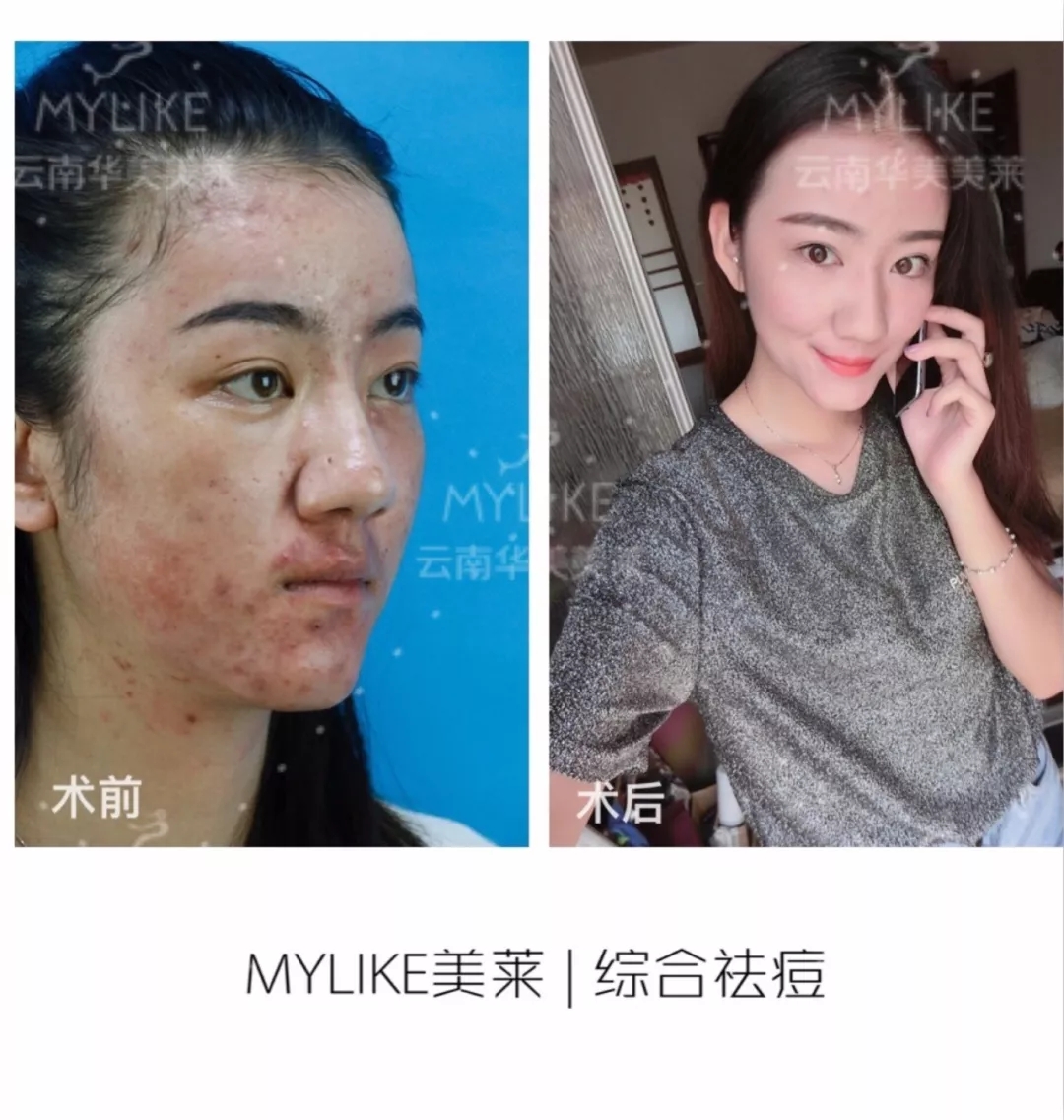 閉口和粉刺有什么區(qū)別，怎么祛除