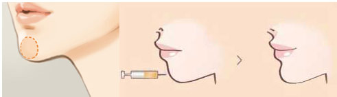 <a href='/gz/' target='_blank'><u>廣州美萊</u></a>注射豐下巴要多少錢(qián)