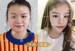 貴陽開眼角要多長時間恢復(fù)