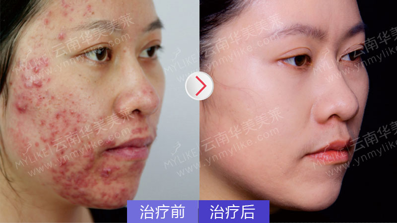 為什么額頭會長痘，怎么祛除？