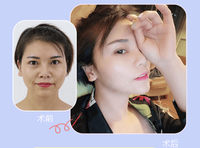 大中小分子玻尿酸有什么區(qū)別，法令紋又是用的什么