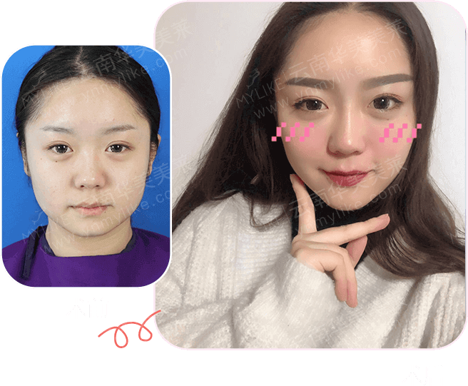 大中小分子玻尿酸有什么區(qū)別，法令紋又是用的什么