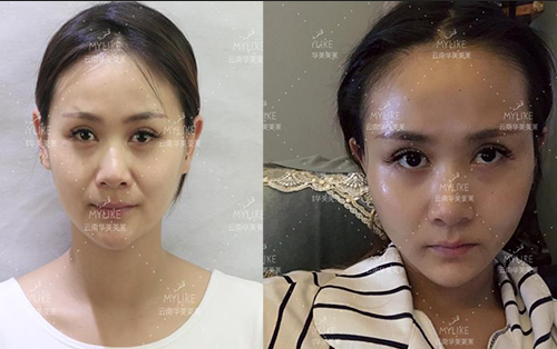 2013年世界旅游小姐西南賽區(qū)季軍必做的醫(yī)美項目！美萊雙十一火爆來襲！