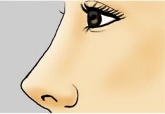 重慶美萊玻尿酸隆鼻價格貴嗎？