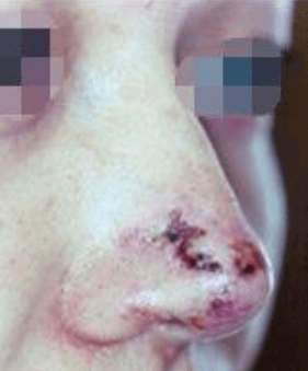 武漢打玻尿酸隆鼻會(huì)不會(huì)留下后遺癥？