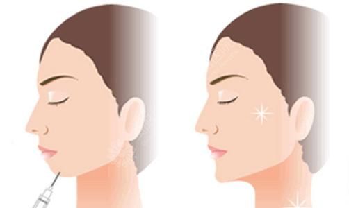 什么因素會影響假體隆下巴的效果呢？