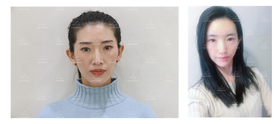 2011年環(huán)球游艇模特大賽十佳及單項獎小姐姐必做的醫(yī)美項目?。∶廊R雙十一get好物推薦