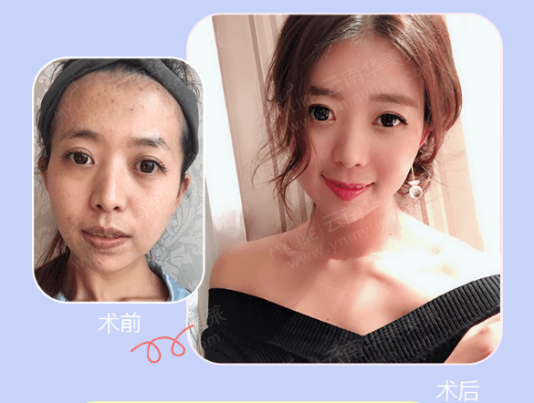 選擇玻尿酸填充面部有副作用嗎，會不會凹凸不平?