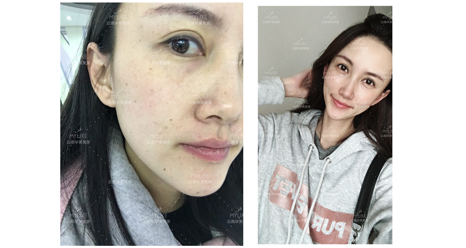 2018年“魅力絲路 時尚昆明”車模大賽勝者必要做的醫(yī)美項目??！美萊雙十一get好物推薦