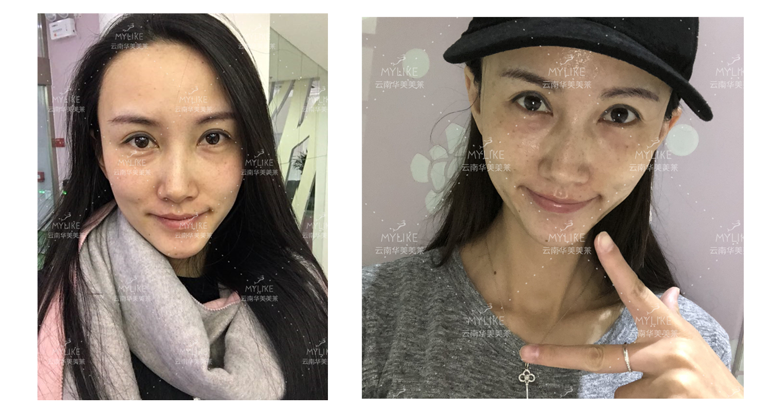 2018年“魅力絲路 時尚昆明”車模大賽勝者必要做的醫(yī)美項目！！美萊雙十一get好物推薦