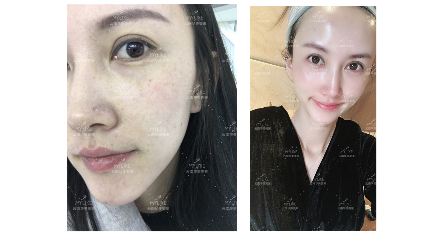 2018年“魅力絲路 時尚昆明”車模大賽勝者必要做的醫(yī)美項目?。∶廊R雙十一get好物推薦