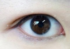 西安美萊內(nèi)雙可不可以做全切雙眼皮手術