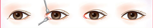 開(kāi)眼角手術(shù)要幾天才能拆線(xiàn)