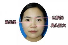 福州假體隆鼻手術(shù)需要多少錢(qián)呢