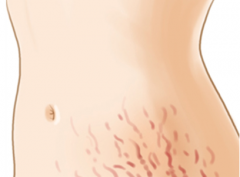 長(zhǎng)沙激光去妊娠紋效果好嗎