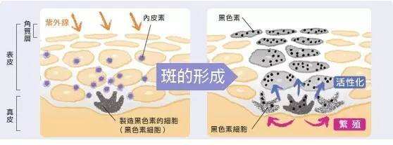 重慶激光去雀斑缺點(diǎn)有哪些