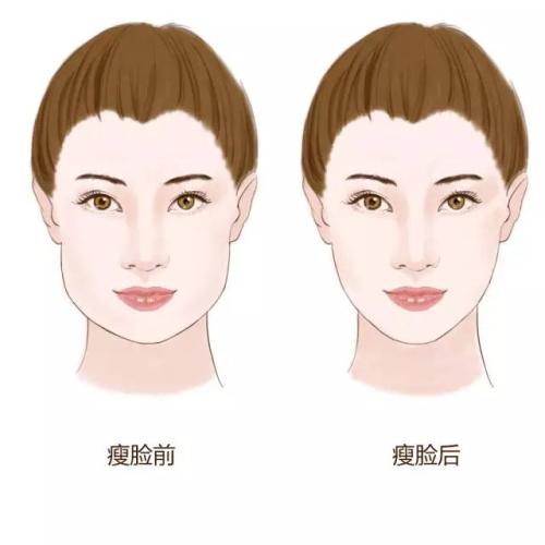 西安瘦臉多少錢(qián)