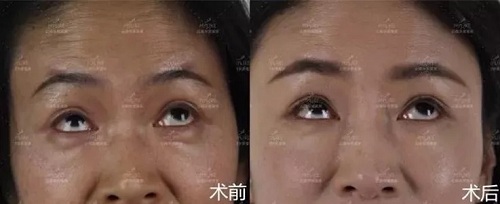 2018年過得很開心的你，皺紋有沒有增多？