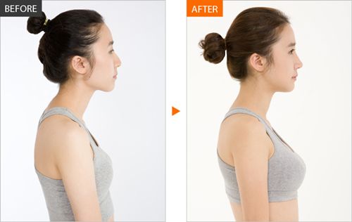 重慶華美自體脂肪豐胸的效果？