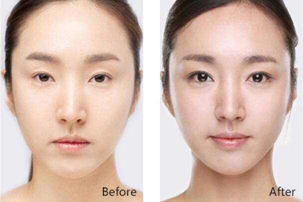 <a href='/wh/' target='_blank'><u>武漢美萊</u></a>開眼角優(yōu)勢大曝光，想要做開眼角的快來看看吧