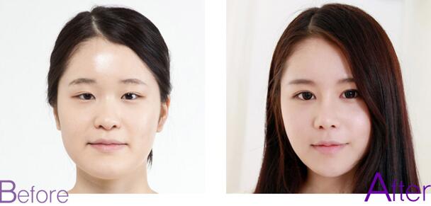 昆明做雙眼皮術(shù)后恢復(fù)快一定會變內(nèi)雙嗎？