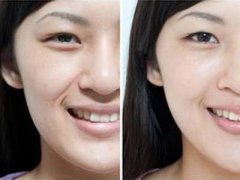 西安怎樣祛法令紋比較有效？