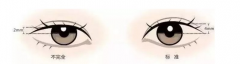 寧波做韓式雙眼皮手術效果自然不自然