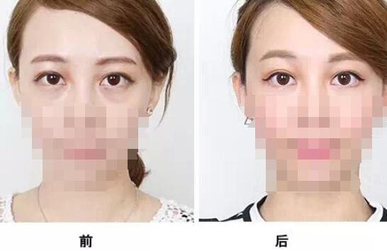通過手術祛眼袋多久看都效果?會有疤痕嗎？