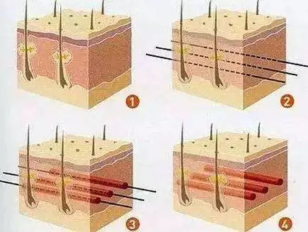 *雕術(shù)能維持多久？