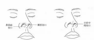 廈門隆鼻后假體一定要取出嗎？