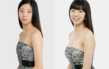 西安注射玻尿酸隆下巴安全嗎，會不會有副作用