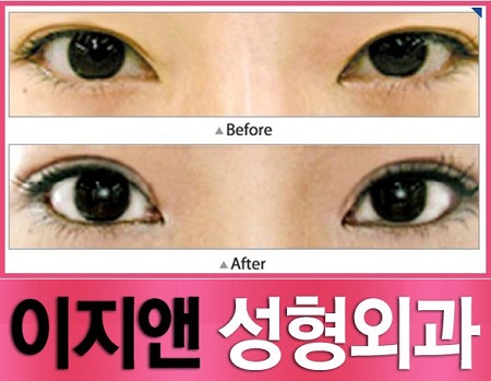 韓式微創(chuàng)雙眼皮多少錢(qián)