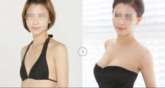 武漢自體脂肪隆胸的效果好不好？