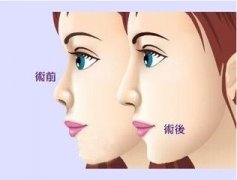 南京玻尿酸隆鼻能維持多長(zhǎng)時(shí)間？