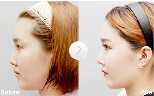 南京玻尿酸隆鼻能維持多長時間?