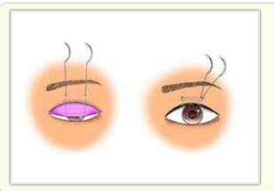 杭州割雙眼皮埋線需要拆線嗎？
