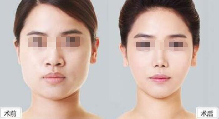 深圳吸脂減肥手術(shù)哪些部位可以做？