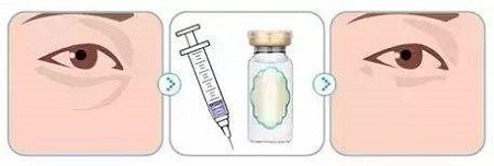 玻尿酸豐淚溝有什么優(yōu)勢(shì)