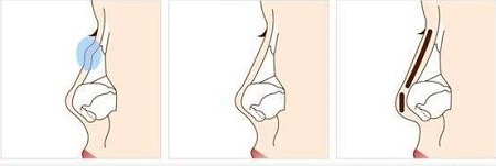 做假體隆鼻第二次對(duì)鼻子危害大嗎