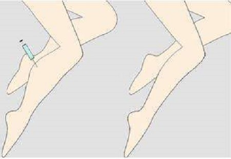 吸脂瘦小腿效果到底好不好