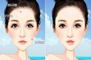 自體脂肪豐額頭