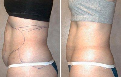 <a href='/xzjf/' target='_blank'><u>吸脂減肥</u></a>手術(shù)多少錢(qián)